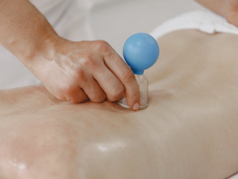 Close-up of dry cupping therapy cups on a person's back